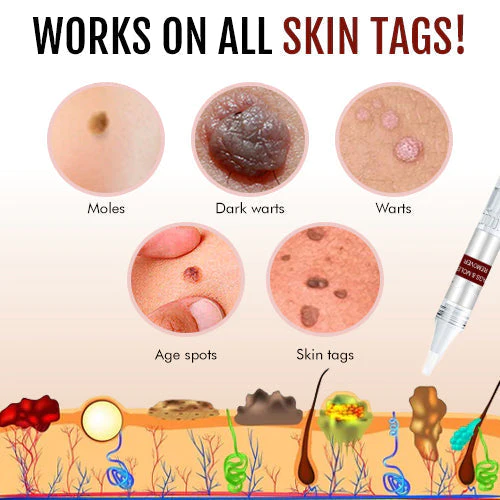 🔥Last Day Promotion 65% OFF🔥🎁 Tags & Moles Remover